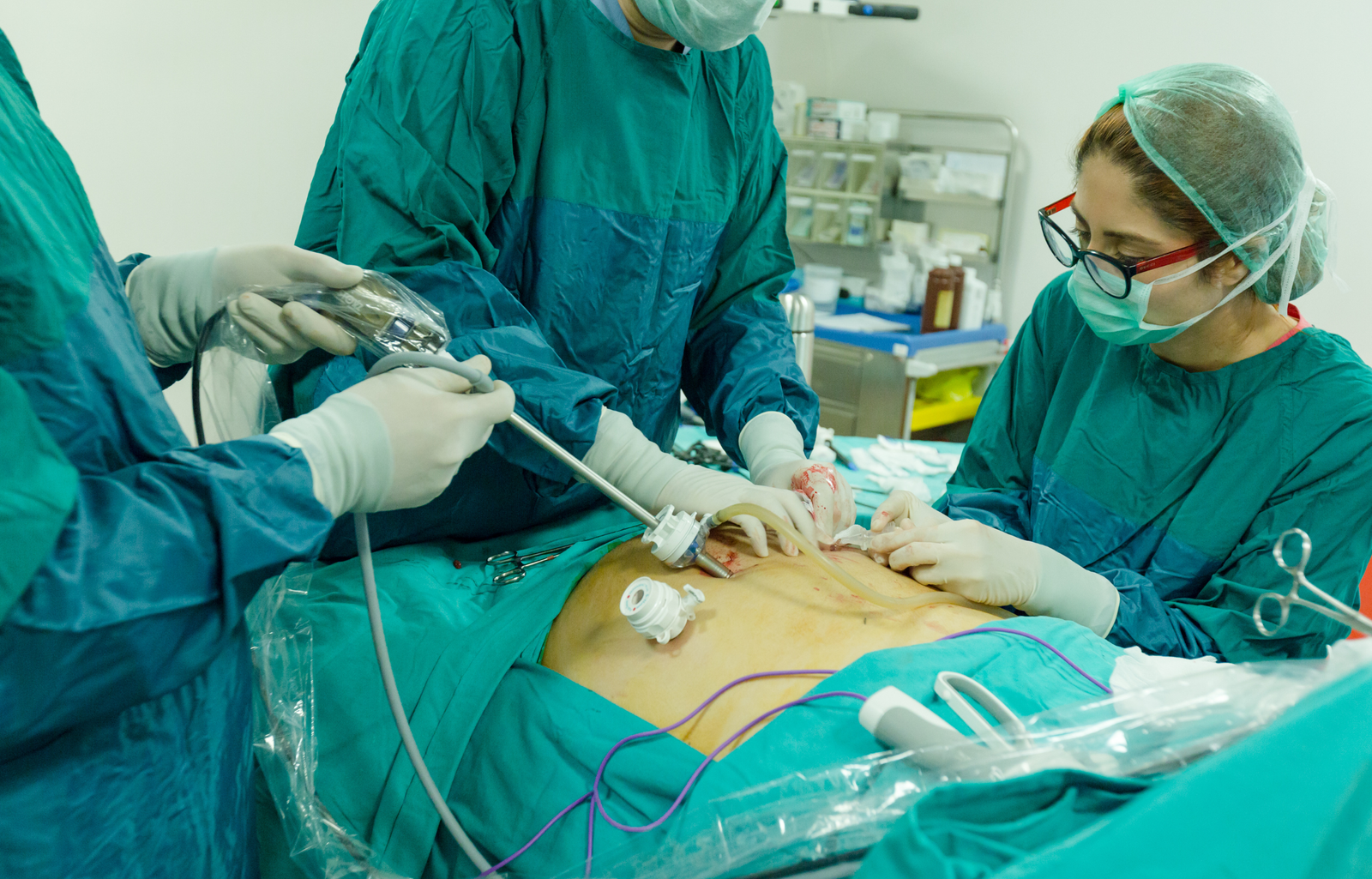 Laparoscopic Cholecystectomy