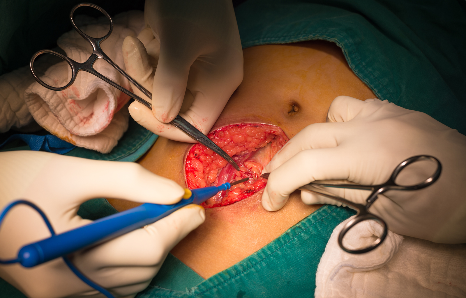 Laparoscopic<br> Appendectomy