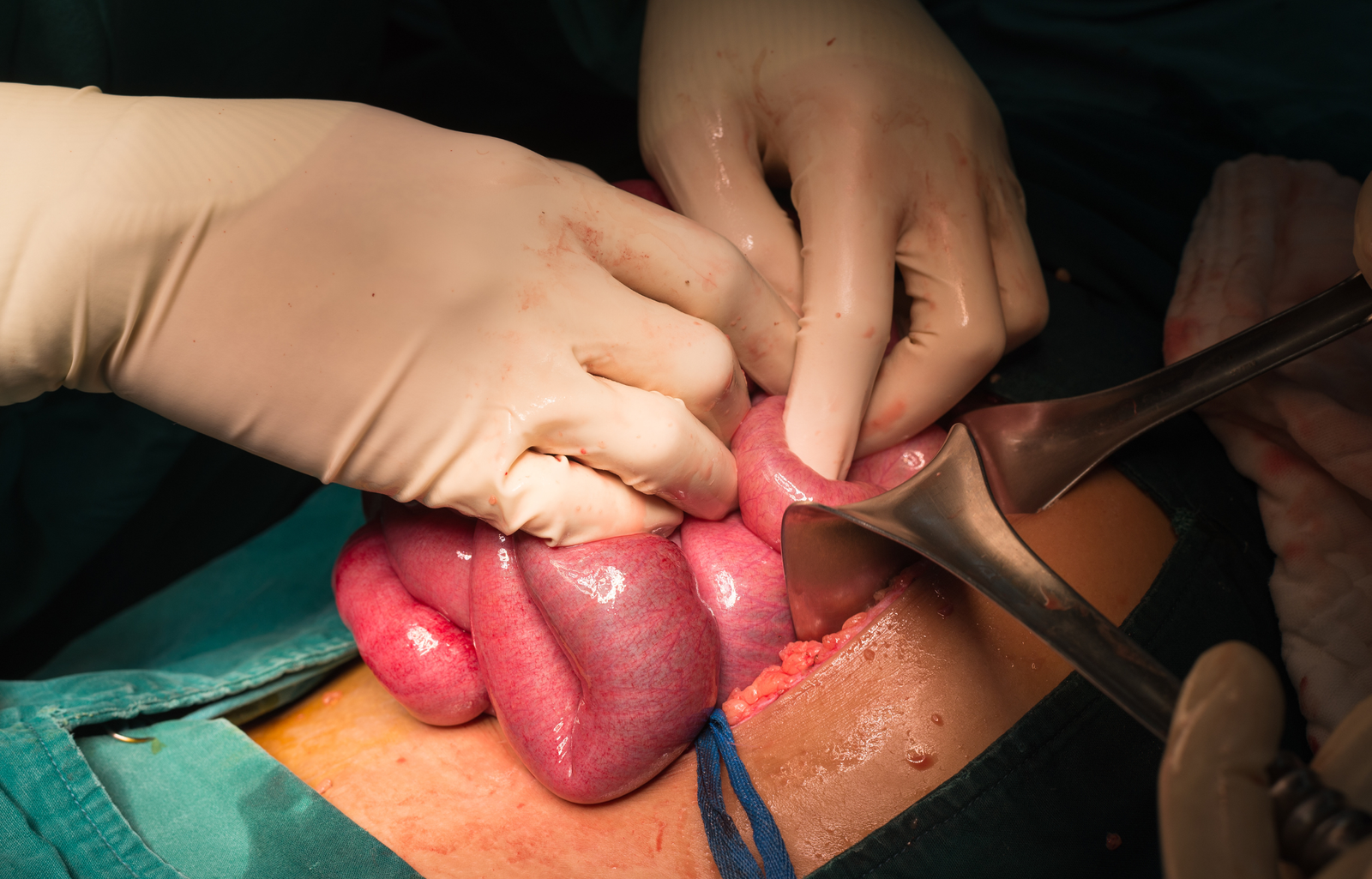 Small Bowel Surgery